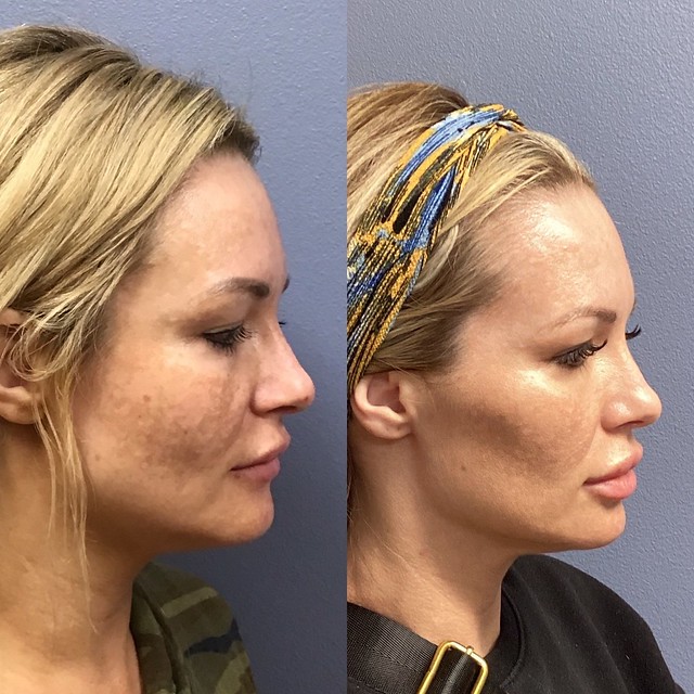 Before and After Juvederm Voluma