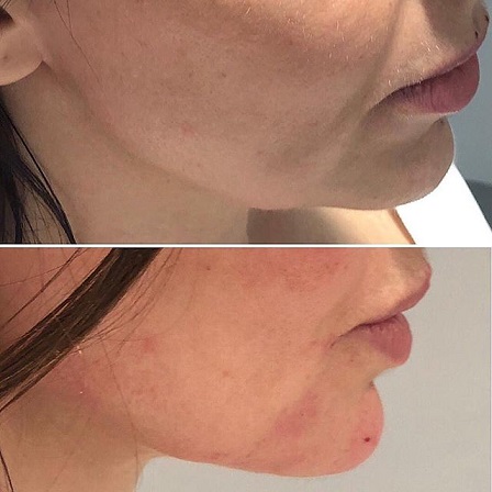 Juvederm Volux Lidocaine Jawline