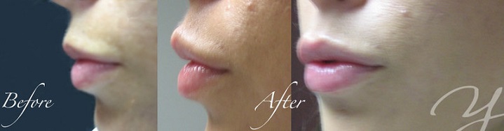 Before and After Juvederm Lips